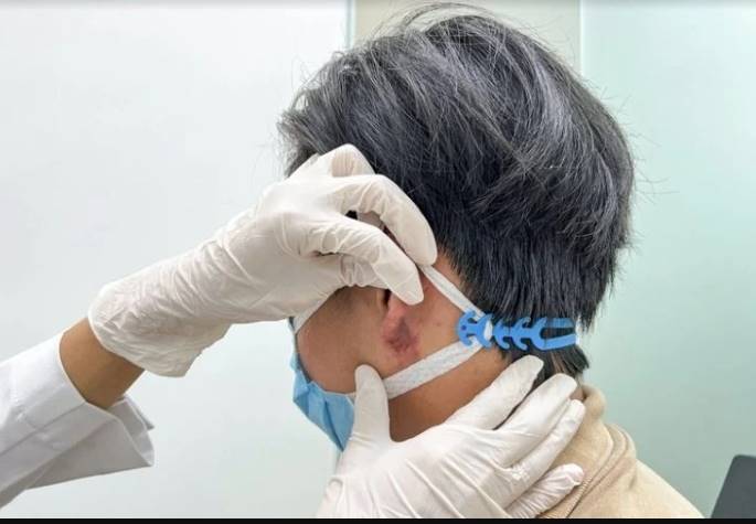 ฉีดฟิลเลอร์ติ่งหู สไตล์พระสังกัจจายน์