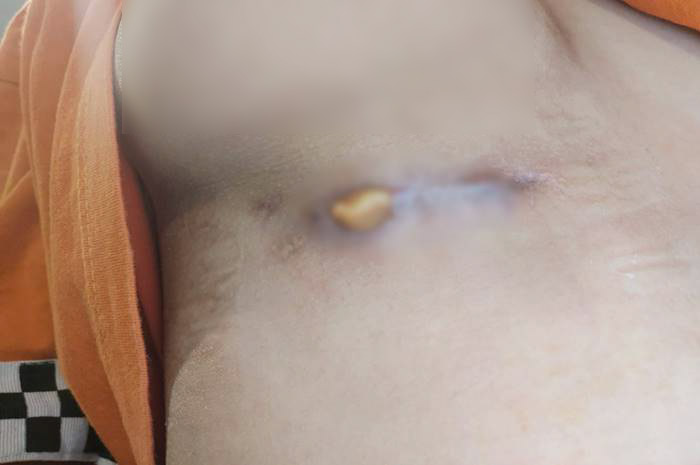 สาวเสริมหน้าอก หมอลืมเอาผ้าก๊อซออก 