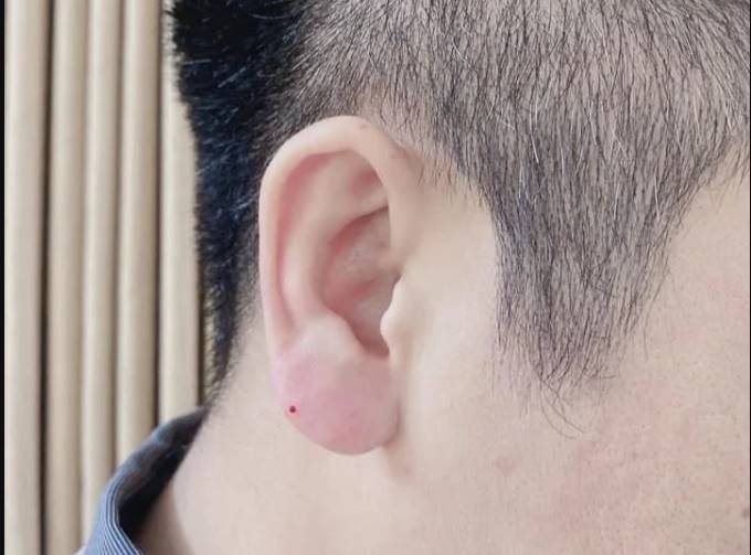 ฉีดฟิลเลอร์ติ่งหู สไตล์พระสังกัจจายน์