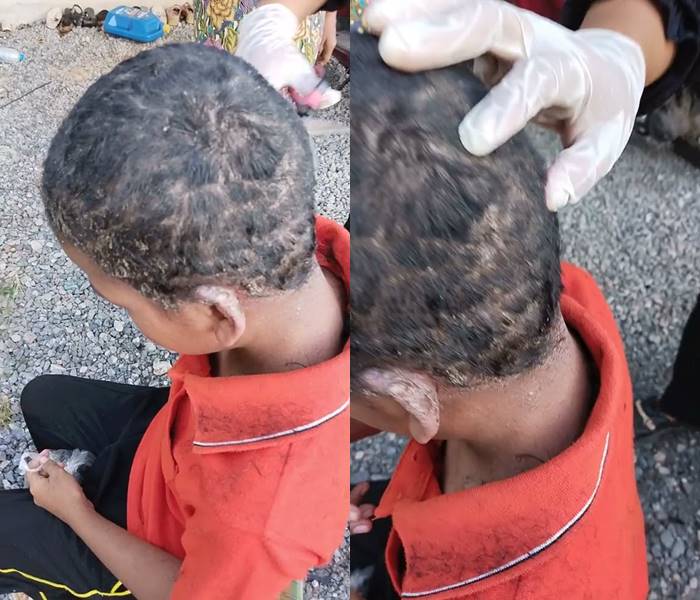 ช่วยเด็ก เหาเต็มหัว ดูดเลือดจนเป็นแผล