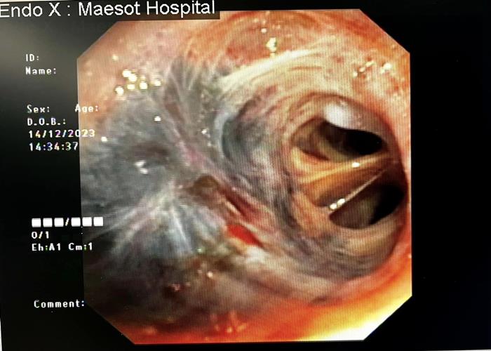 หลอดลมดำ ผลจากการเผา สูดควัน