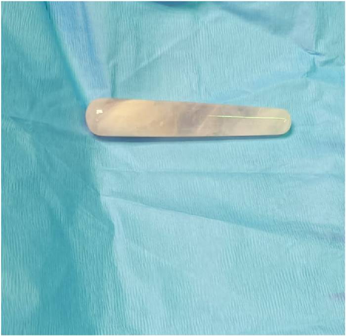 ดิลโด้หลุดเข้ากระเพาะปัสสาวะ