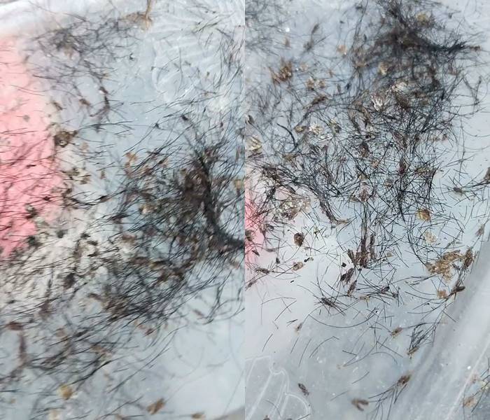 ช่วยเด็ก เหาเต็มหัว ดูดเลือดจนเป็นแผล