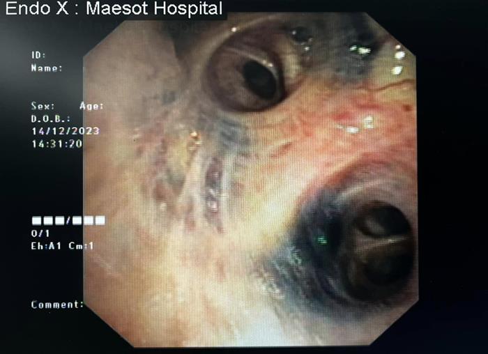 หลอดลมดำ ผลจากการเผา สูดควัน