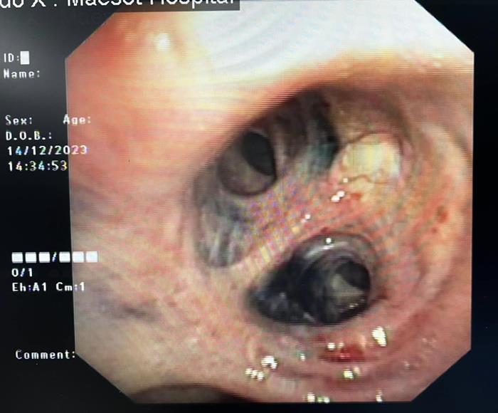 หลอดลมดำ ผลจากการเผา สูดควัน