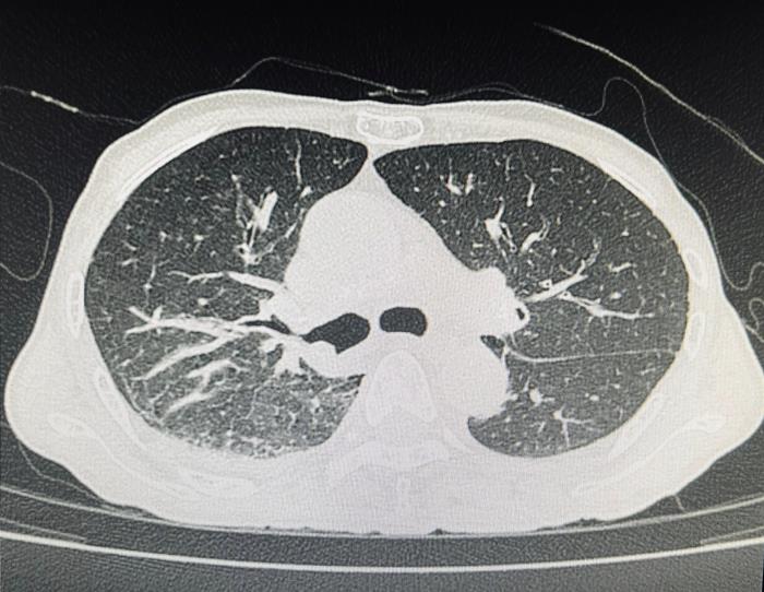 หลอดลมดำ ผลจากการเผา สูดควัน