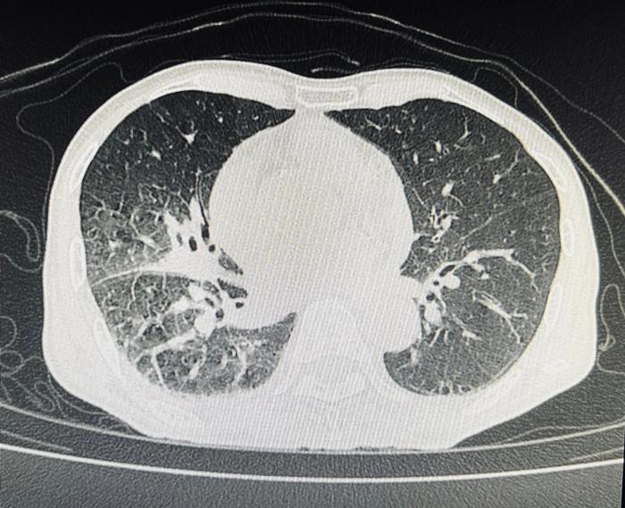 หลอดลมดำ ผลจากการเผา สูดควัน