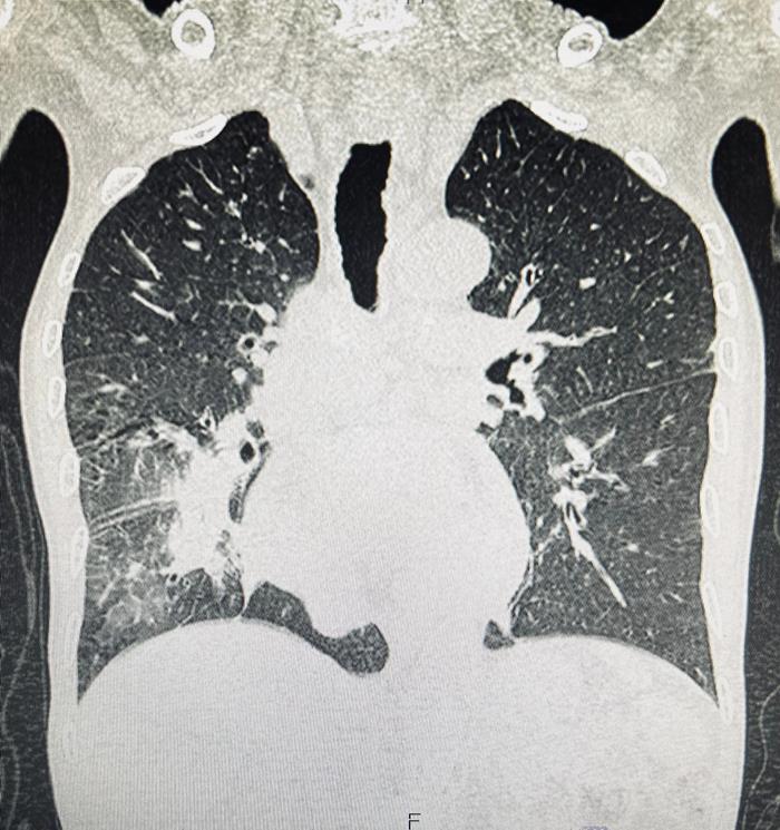 หลอดลมดำ ผลจากการเผา สูดควัน
