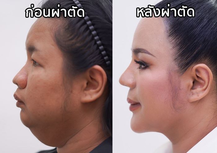 ทหารหญิงรับใช้ ศัลยกรรมหน้าใหม่