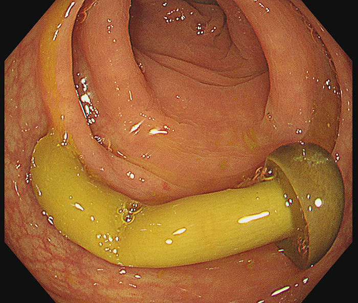เห็ดในลำไส้