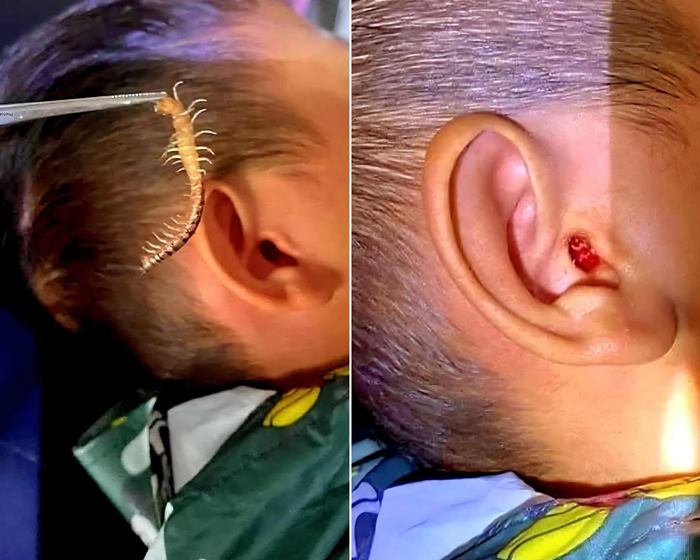 ตะขาบเข้าหูเด็ก