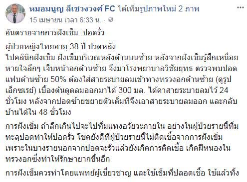 ฝังเข็ม