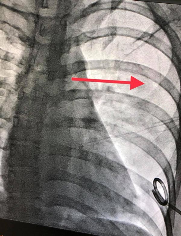 ฝังเข็ม