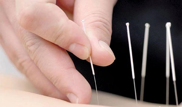 ฝังเข็ม