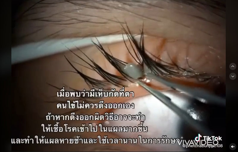 เห็บกัดตา