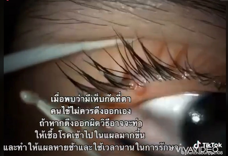 เห็บกัดตา