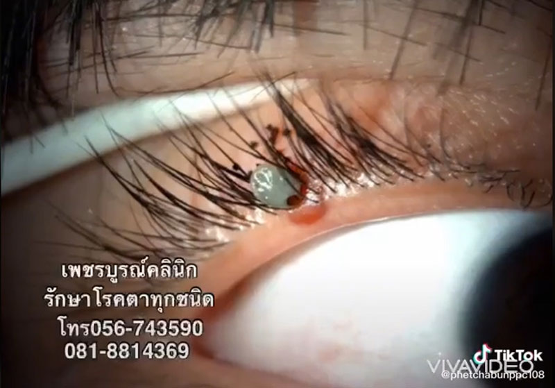 เห็บกัดตา