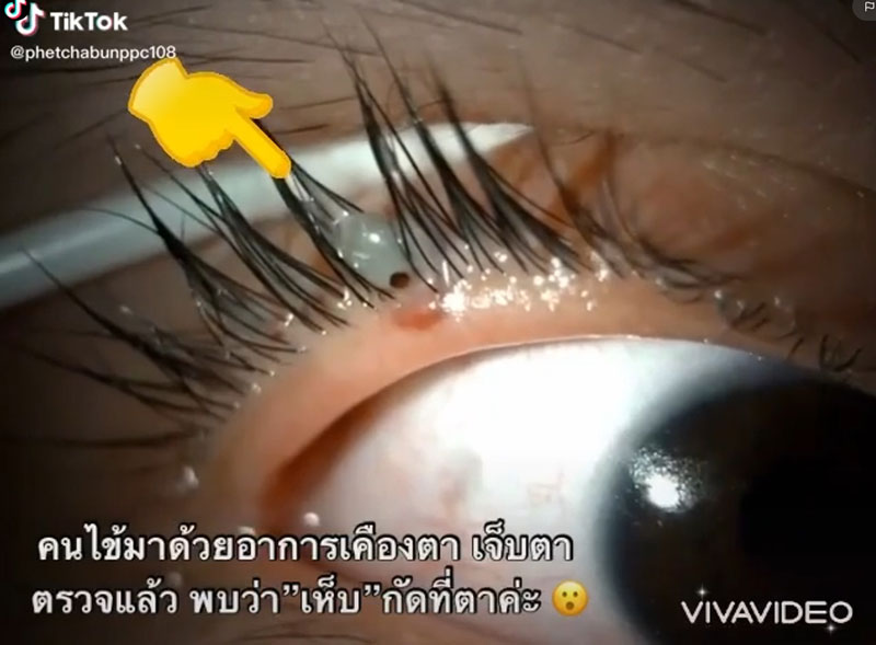 เห็บกัดตา