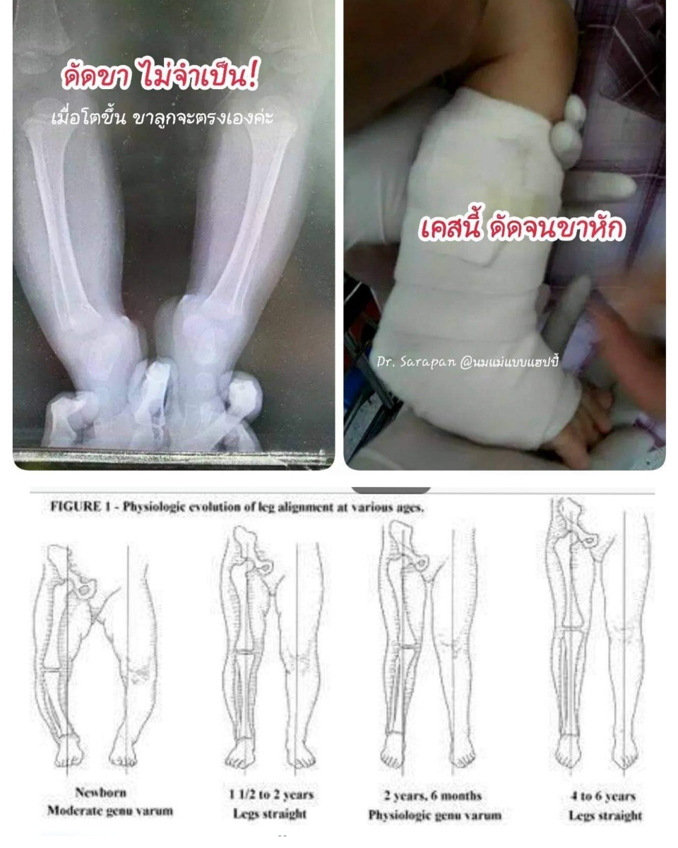 ดัดขาทารกหัก