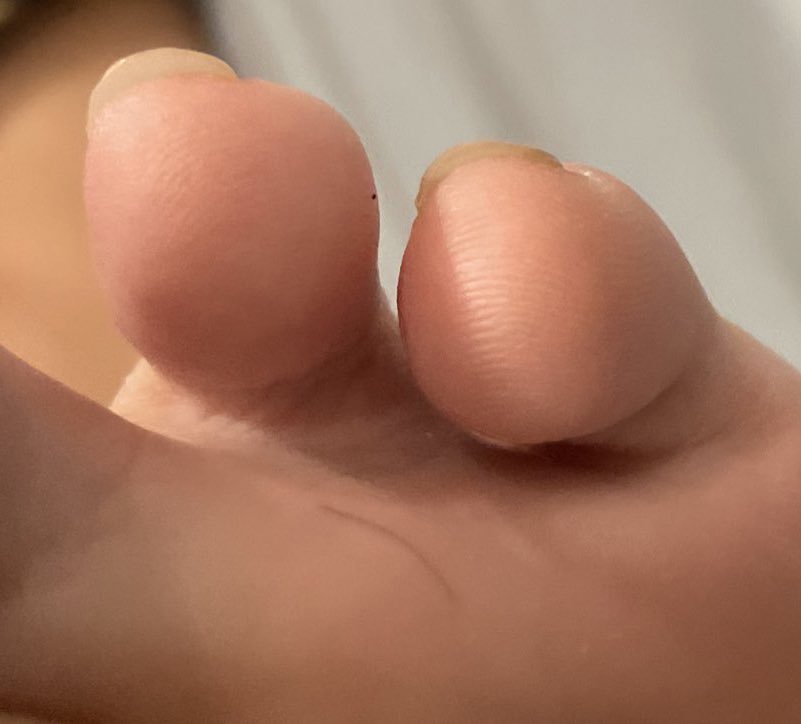 ผมตำเท้า