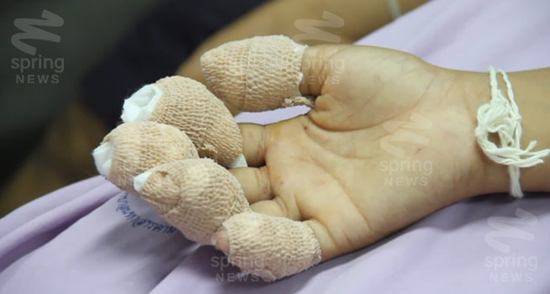 เด็ก 9 ขวบ เล่นประทัดสามเหลี่ยม บึ้มใส่มือขวาเละทั้ง 5 นิ้ว