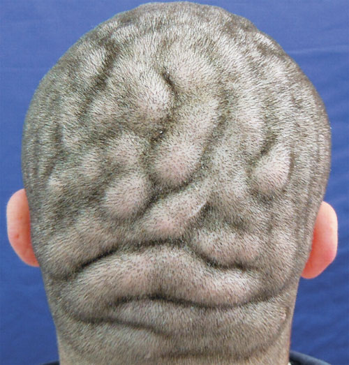 หนุ่มบราซิลป่วยแปลก หัวตะปุ่มตะป่ำคล้ายสมอง