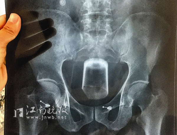 ชายสุดซวยเอาแก้วยัดทวารหนักหวังรักษาท้องผูก แต่ดันเอาไม่ออก