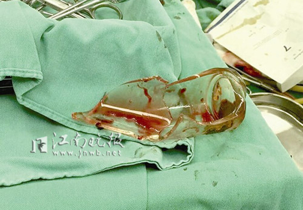 ชายสุดซวยเอาแก้วยัดทวารหนักหวังรักษาท้องผูก แต่ดันเอาไม่ออก