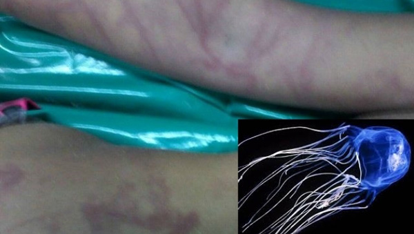 แมงกะพรุนกล่องกัด