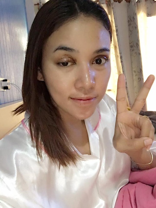 อุทาหรณ์ ฉีดฟิลเลอร์ เถื่อน