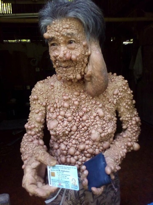 ท้าวแสนปม