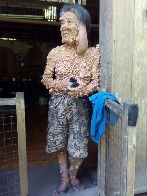 ท้าวแสนปม