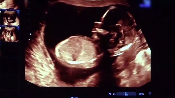   ไคลี่ เจนเนอร์ 