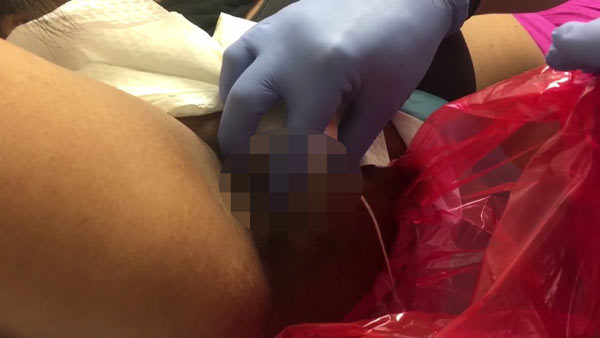 ฝีที่รักแร้