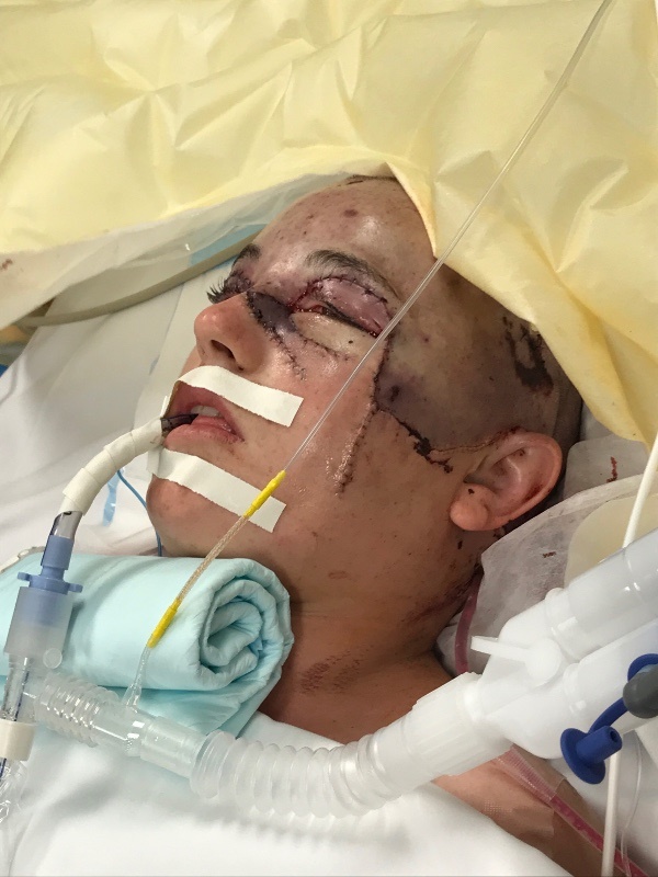  หนังหัวหลุดจากกะโหลก