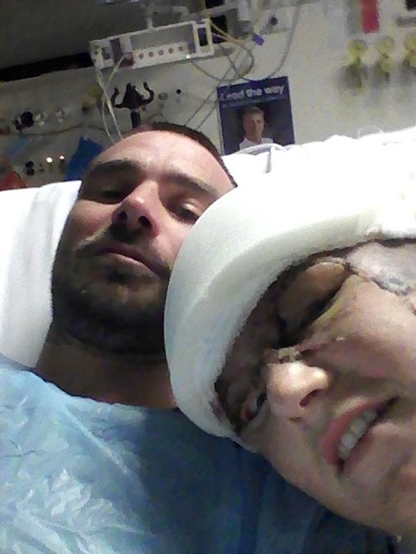  หนังหัวหลุดจากกะโหลก