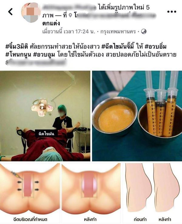 ฉีดไขมันเข้าจิ๊มิ