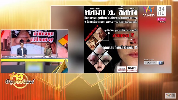เสริมจมูก