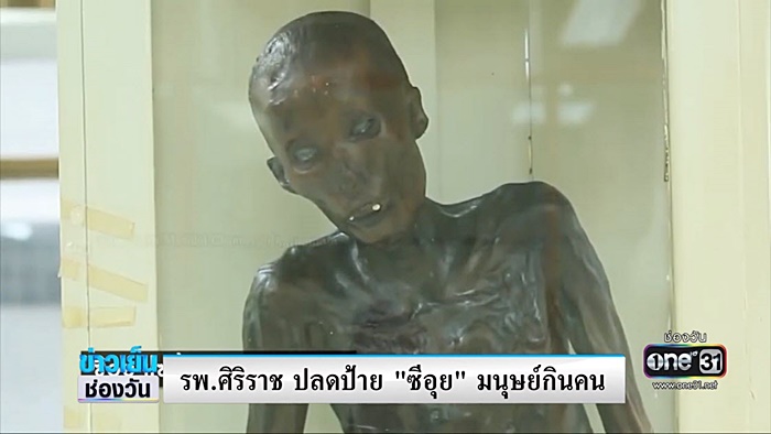 ศิริราชปลดป้าย มนุษย์กินคน พ้นร่าง ซีอุย