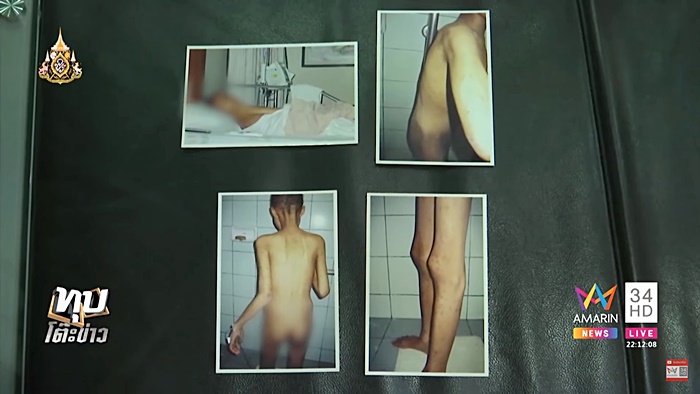 ป่วยเอดส์ 