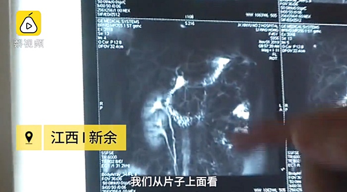 มีไต 3 ข้าง