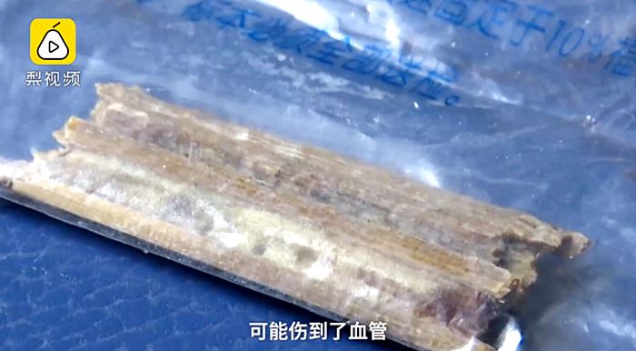 กิ่งไม้ฝังในกะโหลก