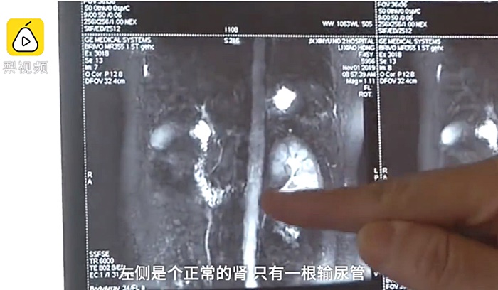 มีไต 3 ข้าง