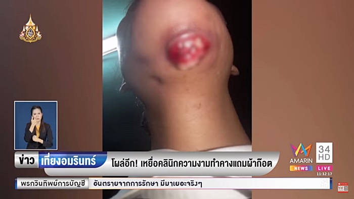 ศัลยกรรมหน้าพัง