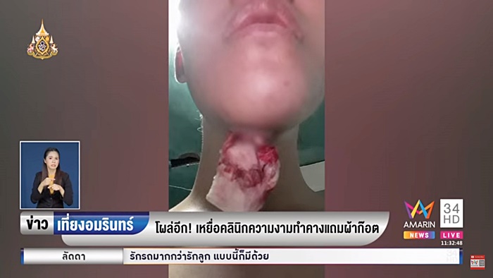 ศัลยกรรมหน้าพัง