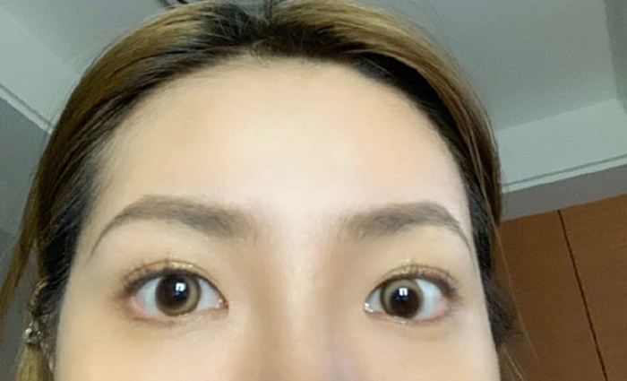 คอนแทคเลนส์