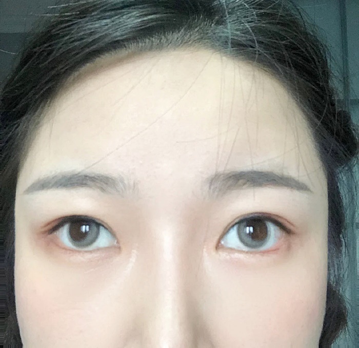 คอนแทคเลนส์