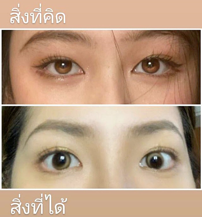 คอนแทคเลนส์