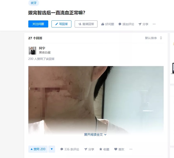 พี่สาวช็อก น้องเสียชีวิต เหตุผ่าฟันคุด