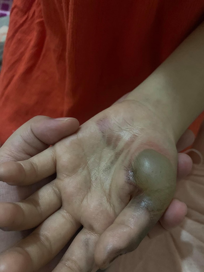   ปลั๊กระเบิดใส่มือลูก  